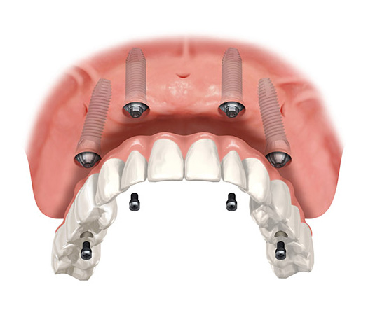 Rehabilitación oral