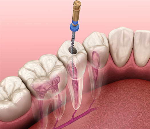 Endodoncias