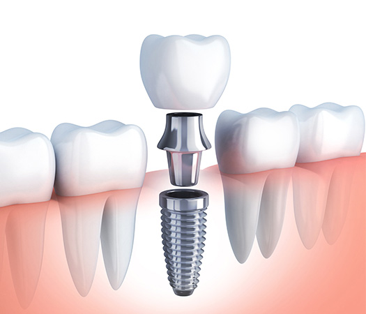 IMPLANTES DENTALES